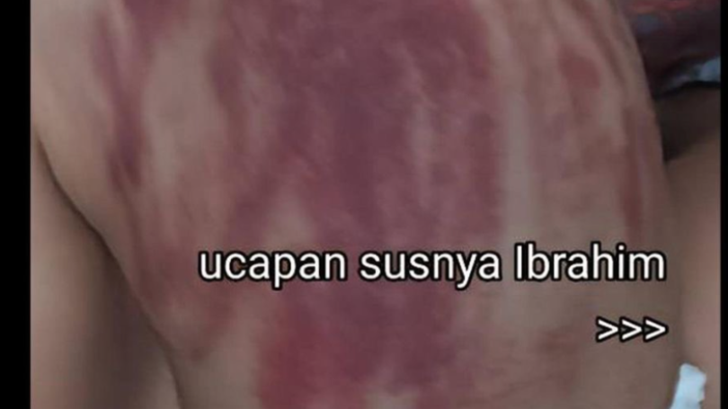 Kronologi Bayi 13 Bulan Dikeroki Hingga Punggung Merah [Twitter: @sosmedkeras]