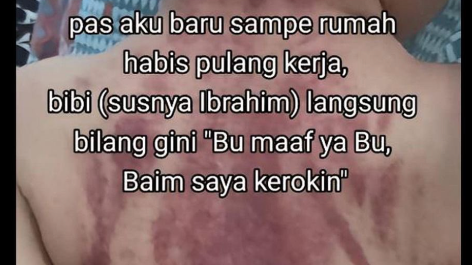 Kronologi Bayi 13 Bulan Dikerok Baby Sitter, Penampakan Punggung Bikin ...